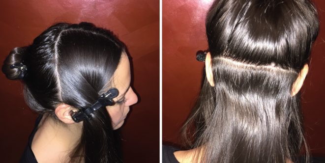 depilaci&oacute;n laser