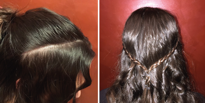 Depilaci&oacute;n laser