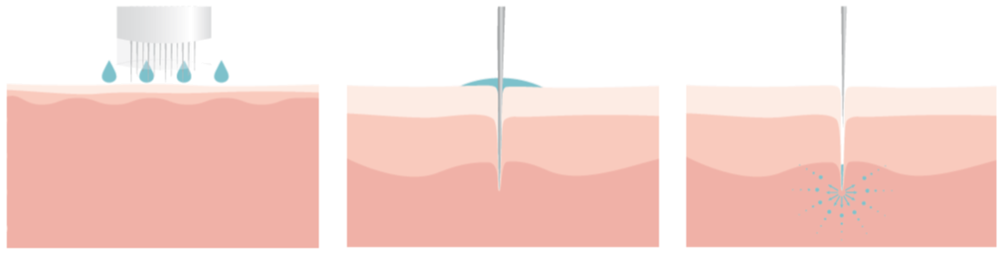 Microneedling