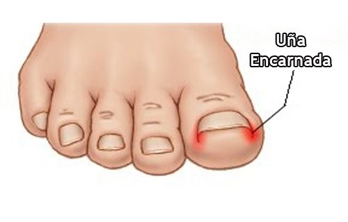 uña encarnada